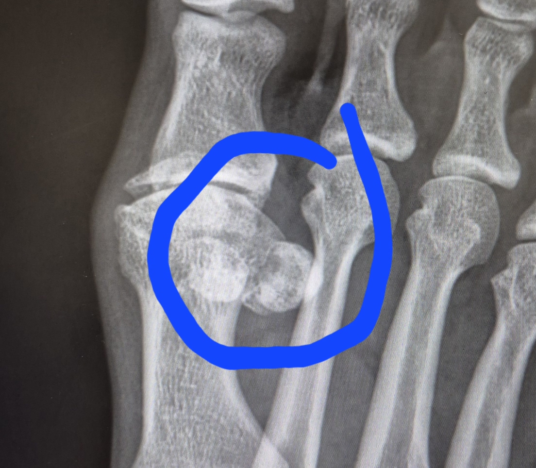 Have-To-Have-Toe-Surgery.