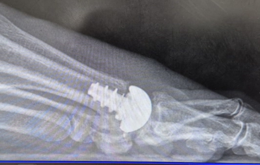 Have-To-Have-Toe-Surgery.