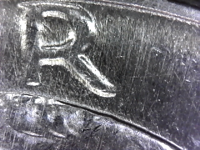Can-MD-Cause-The-Appearance-Of-Peg-Leg?