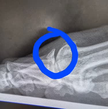 Have-To-Have-Toe-Surgery.
