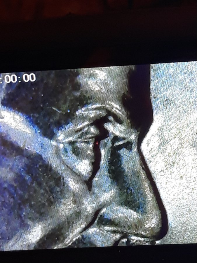 2001-D-LMC-Doubled-Eyelid-Or-Split-Plate-Bubbling?