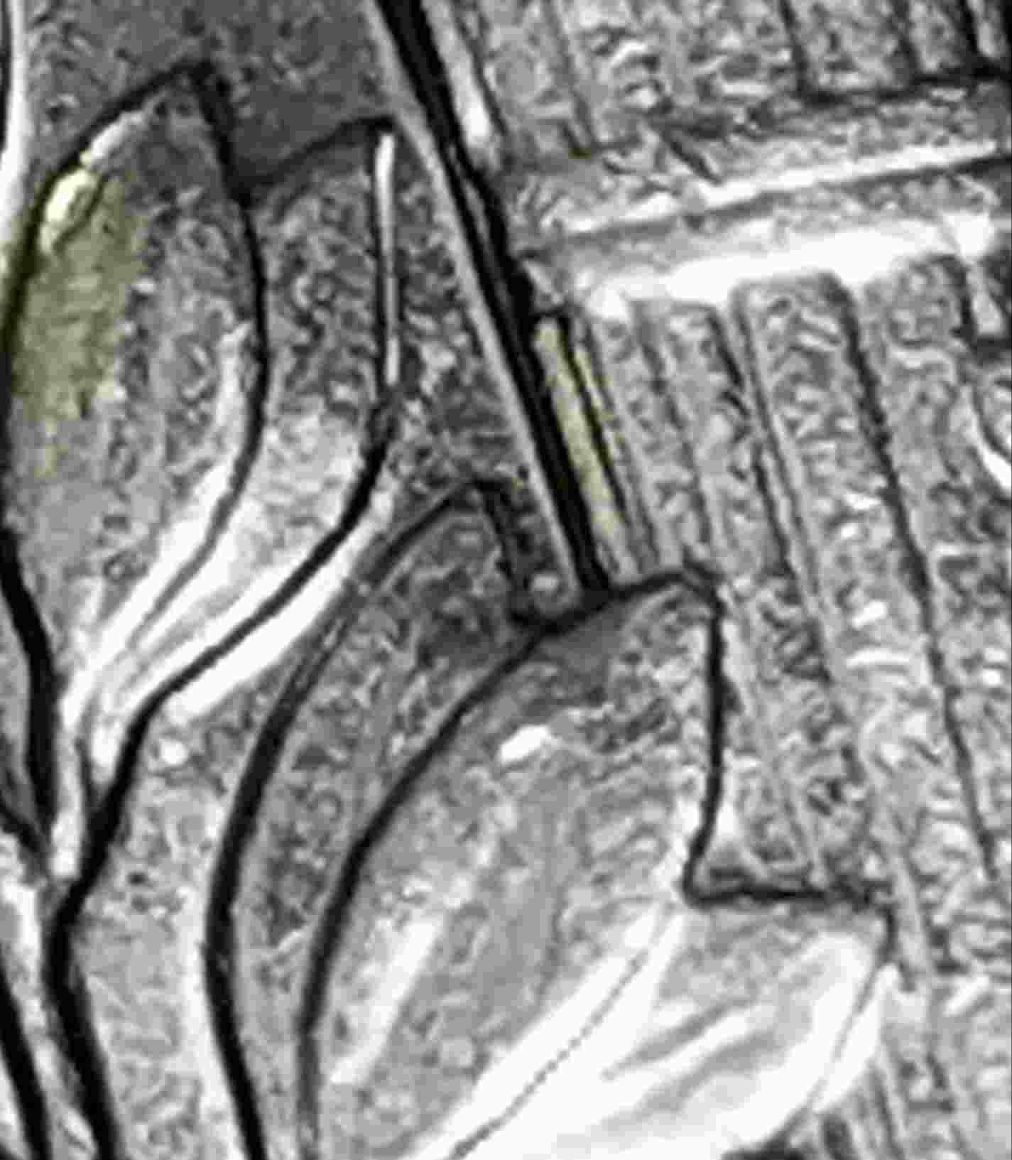 2008-D-Roosevelt-Dime,--Poss.-Doubling-On-Rear-Left-Leaves?