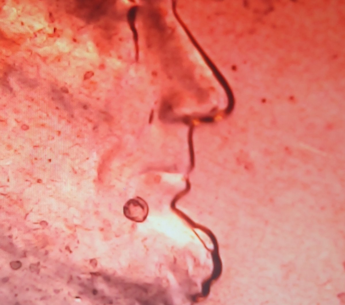 2019-D-Lincoln-Has-A-Pimple