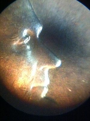 1968-S-DDO-Eyelid