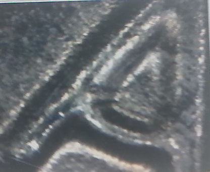 1985-D--Cent-Double-Die?